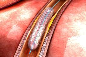 Arterial revascularisation by angioplasty