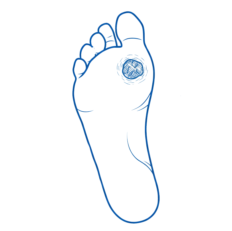 Diabetic foot ulcer
