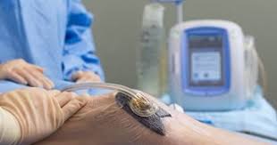 Negative-pressure wound therapy (VAC)